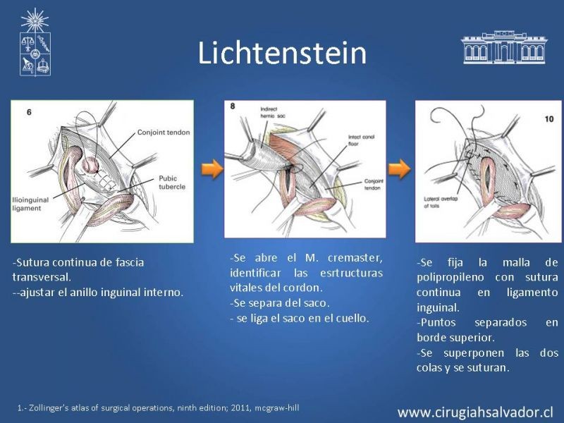 Diapositiva 11 de Hernia inguinal
