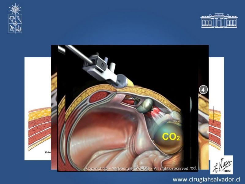Diapositiva 16 de Laparoscopia en Hernia Inguinal