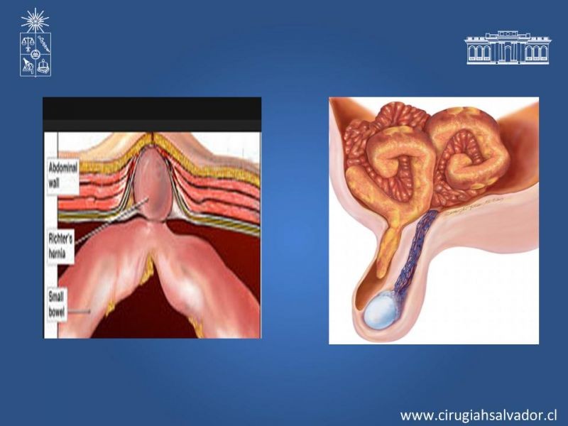Diapositiva 7 de Hernia Crural 1