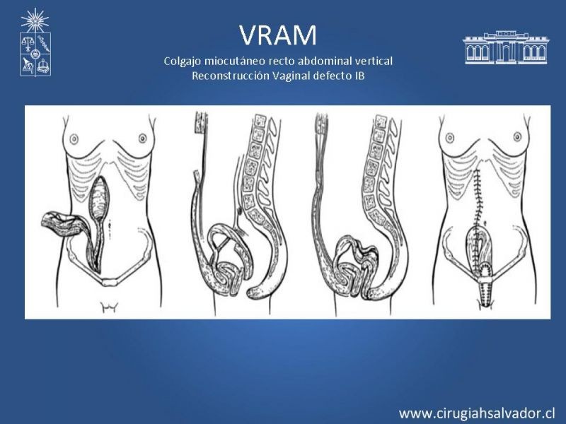 Diapositiva 14 de Transfusiones en Cirugía Mayor Abdominal pt. 2