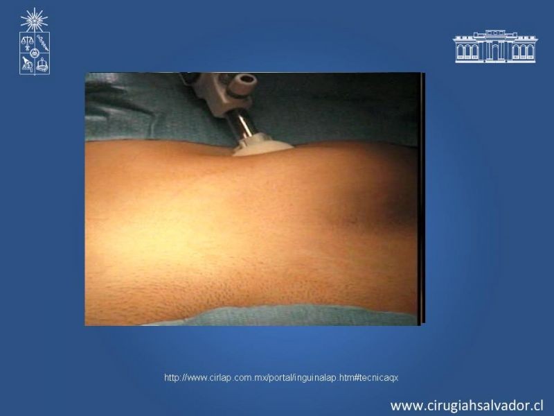 Diapositiva 14 de Laparoscopia en Hernia Inguinal