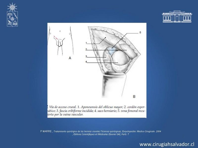 Diapositiva 10 de Hernia Crural 1