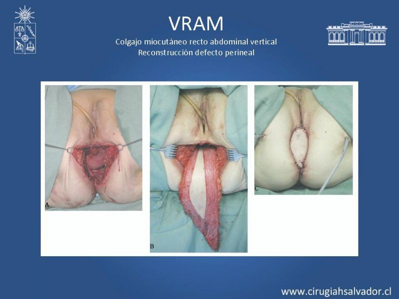 Diapositiva 19 de Transfusiones en Cirugía Mayor Abdominal pt. 2