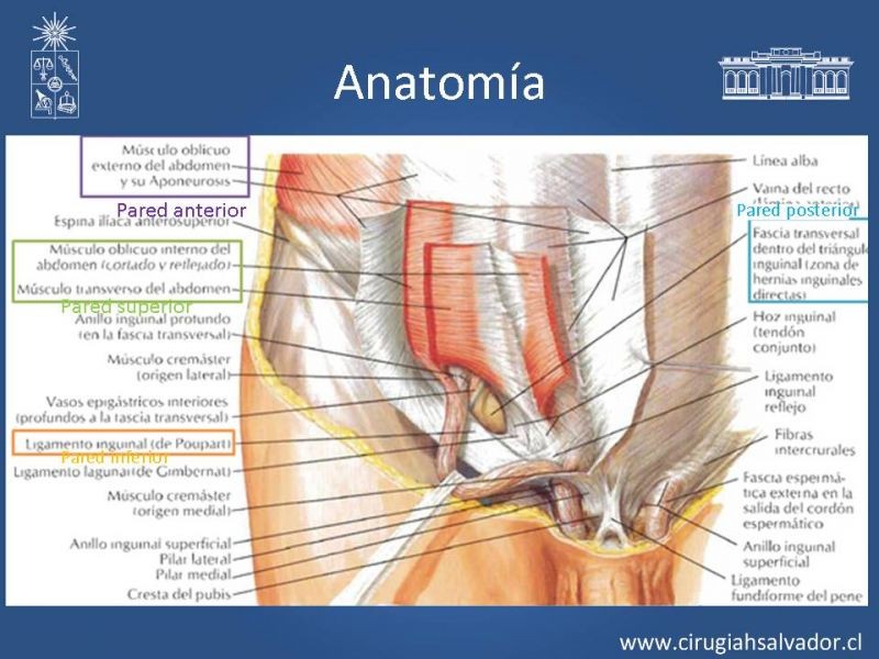 Diapositiva 3 de Hernia inguinal