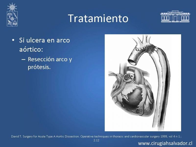 Diapositiva 16 de Disección aórtica tipo A