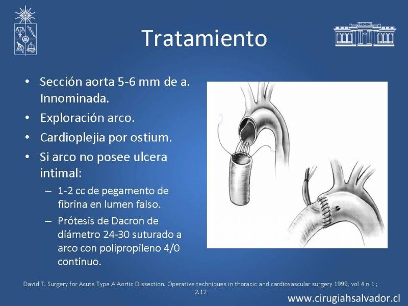 Diapositiva 15 de Disección aórtica tipo A