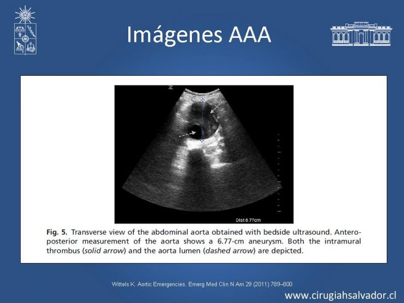 Diapositiva 16 de Aneurisma de Aorta Abdominal:Generalidades