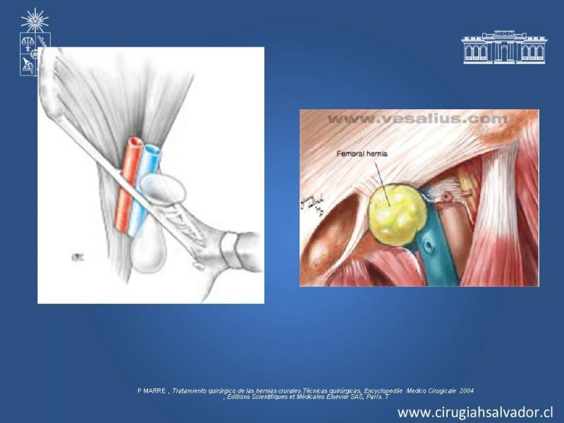 Diapositiva 4 de Hernia Crural 1