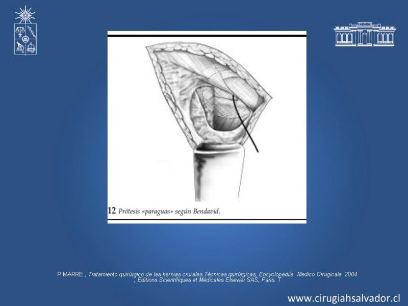 Diapositiva 29 de Hernia Crural 1