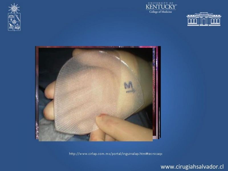 Diapositiva 21 de Laparoscopia en Hernia Inguinal