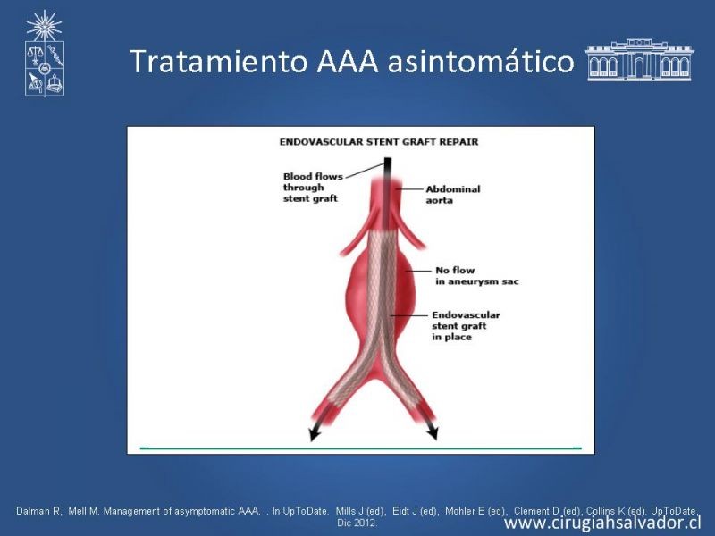 Diapositiva 25 de Aneurisma de Aorta Abdominal:Generalidades