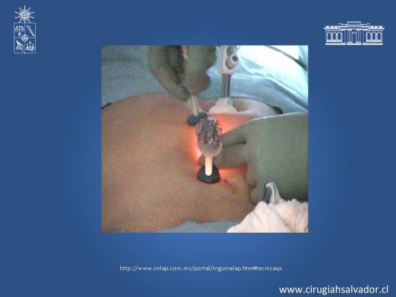 Diapositiva 17 de Laparoscopia en Hernia Inguinal