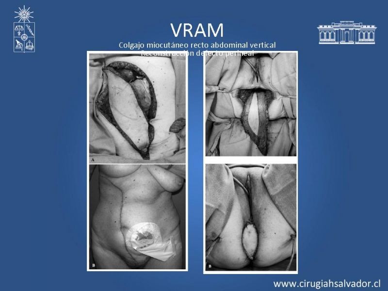 Diapositiva 18 de Transfusiones en Cirugía Mayor Abdominal pt. 2