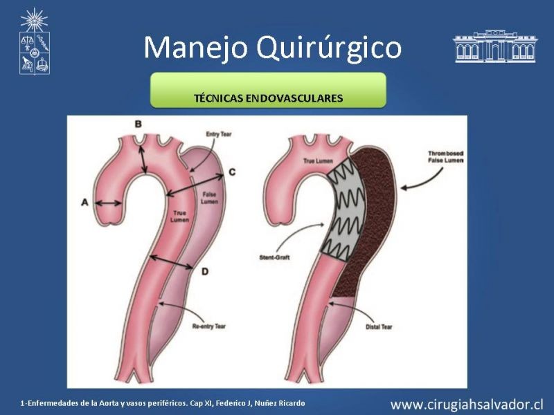 Diapositiva 15 de Manejo Disección Aórtica Tipo B