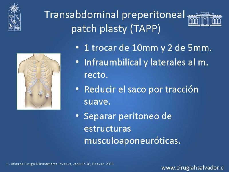 Diapositiva 13 de Hernia inguinal