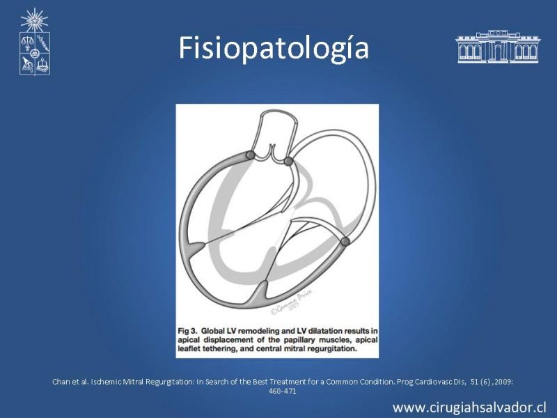 Diapositiva 9 de Insuficiencia Mitral Isquémica