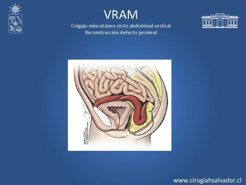 Diapositiva 17 de Transfusiones en Cirugía Mayor Abdominal pt. 2