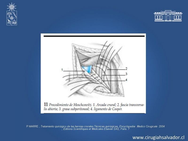 Diapositiva 25 de Hernia Crural 2