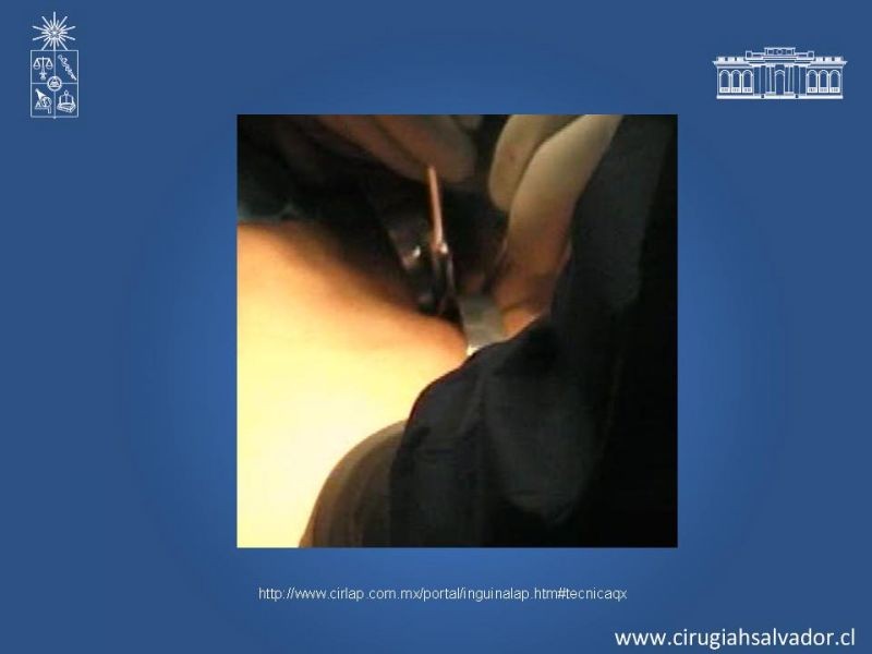Diapositiva 13 de Laparoscopia en Hernia Inguinal