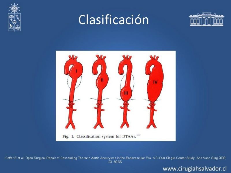 Diapositiva 7 de Reparación endovascular de aneurismas de aorta torácica (TEVAR)