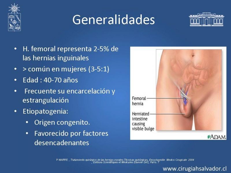 Diapositiva 5 de Hernia Crural 1