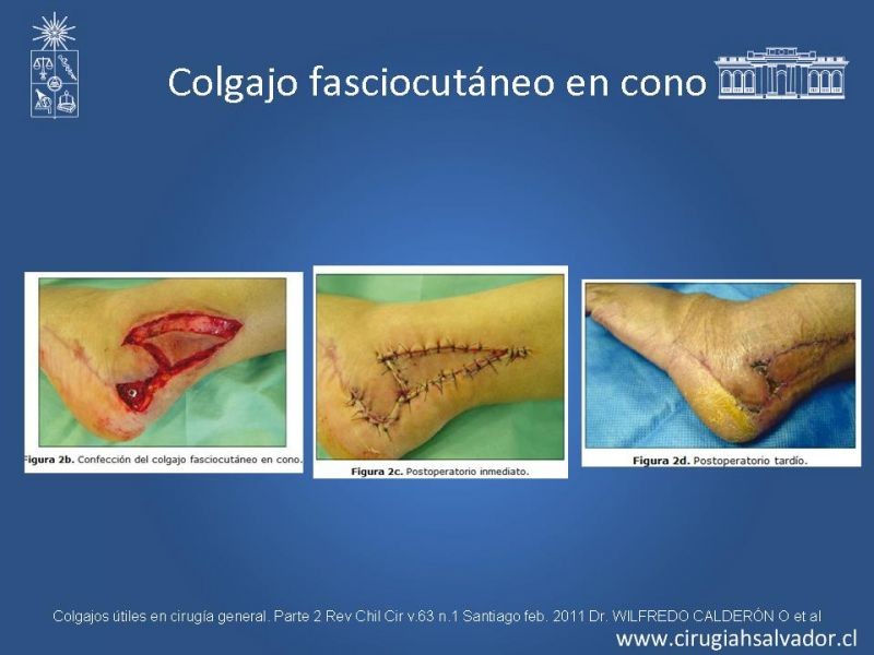 Diapositiva 14 de Colgajos útiles en cirugía general