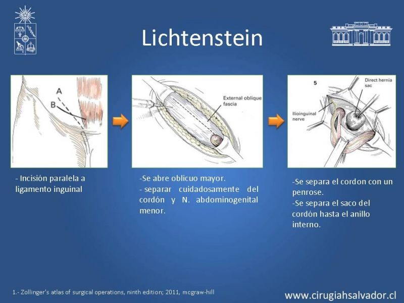 Diapositiva 10 de Hernia inguinal
