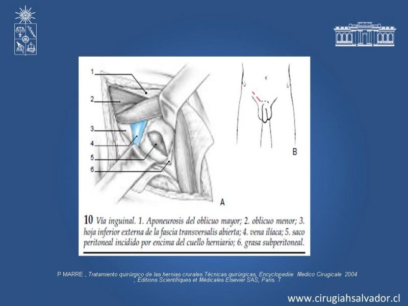 Diapositiva 24 de Hernia Crural 1