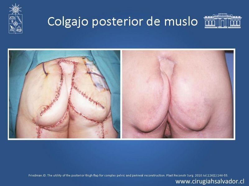 Diapositiva 36 de Transfusiones en Cirugía Mayor Abdominal pt. 2