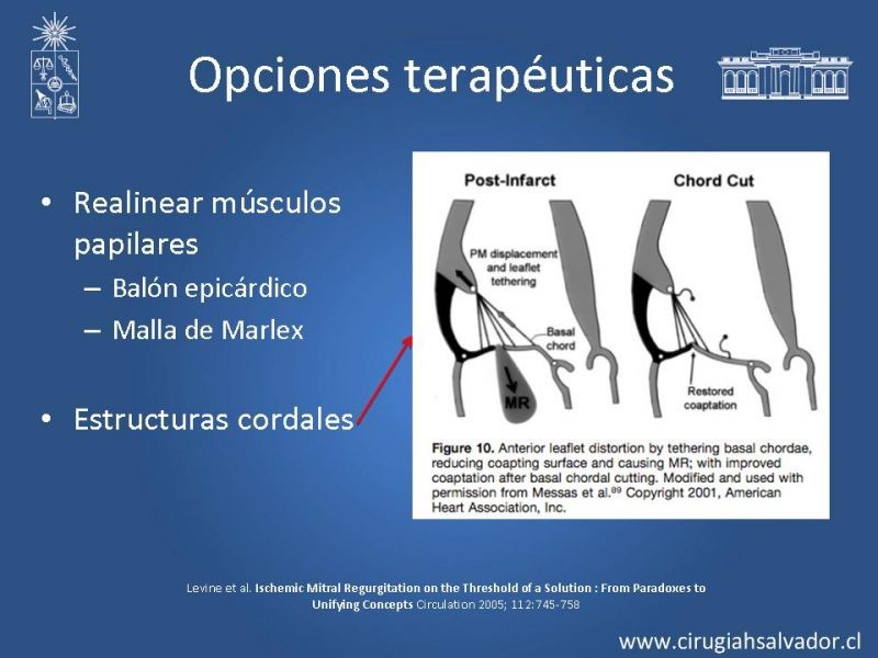 Diapositiva 14 de Insuficiencia Mitral Isquémica
