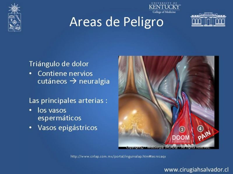 Diapositiva 24 de Laparoscopia en Hernia Inguinal
