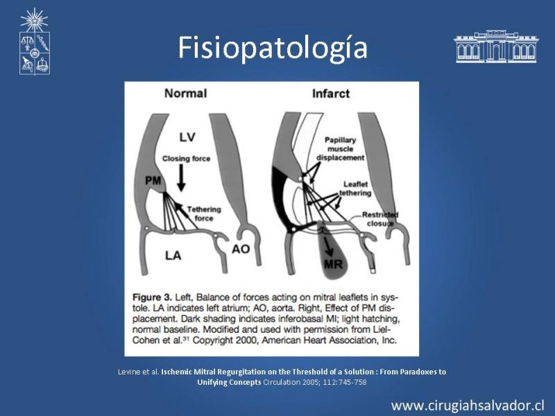 Diapositiva 4 de Insuficiencia Mitral Isquémica