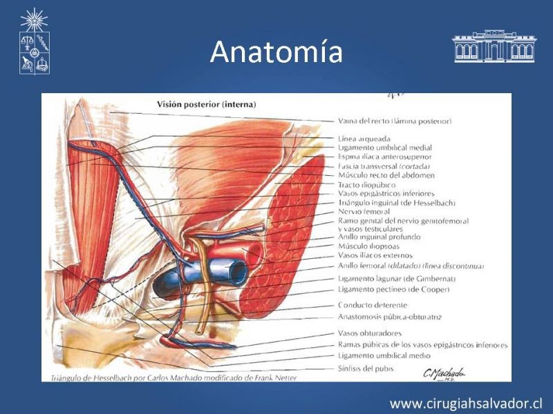 Diapositiva 4 de Hernia inguinal