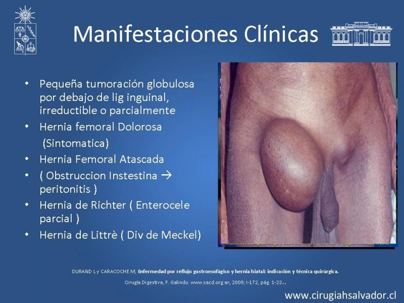 Diapositiva 6 de Hernia Crural 1