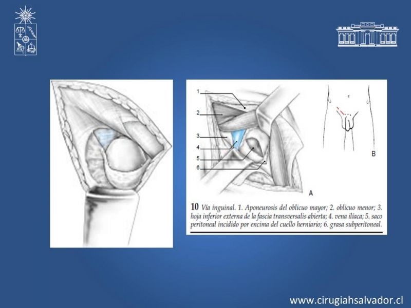 Diapositiva 20 de Hernia Crural 2