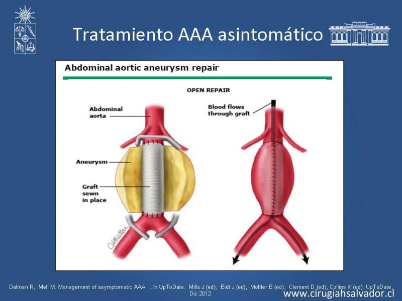 Diapositiva 24 de Aneurisma de Aorta Abdominal:Generalidades