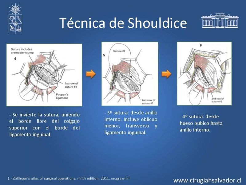 Diapositiva 8 de Hernia inguinal