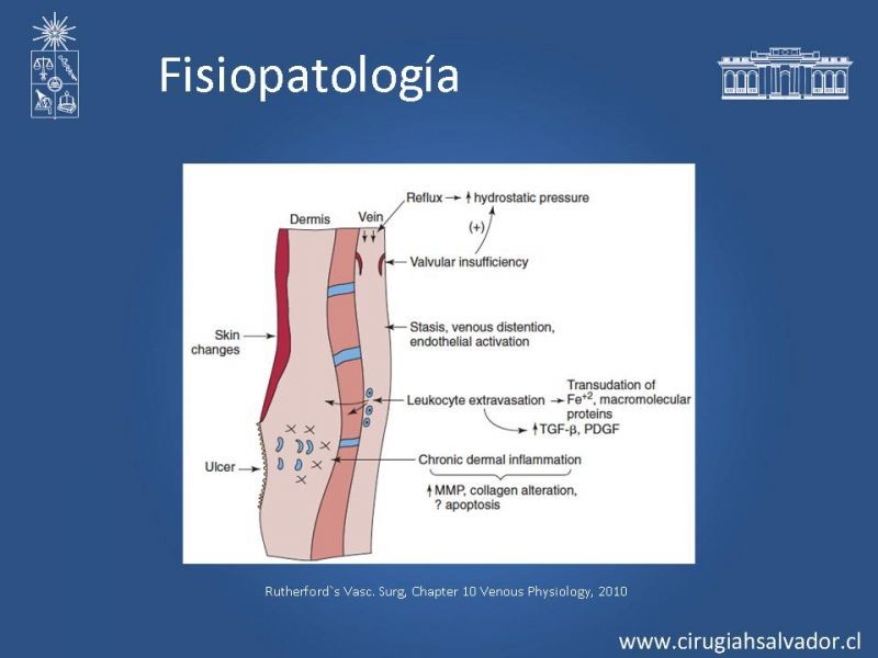 Diapositiva 7 de Insuficiencia Venosa superficial