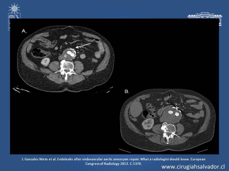 Diapositiva 25 de Endoleak post EVAR