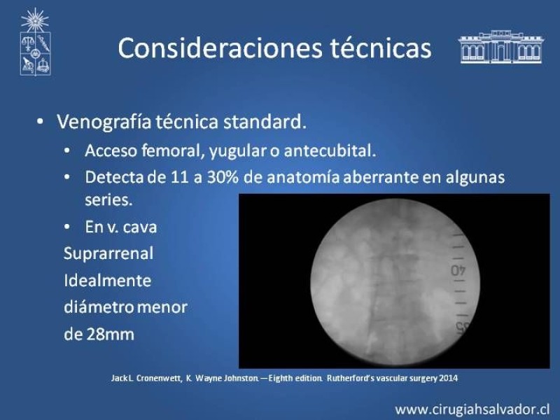 Diapositiva 14 de Filtro de Vena Cava