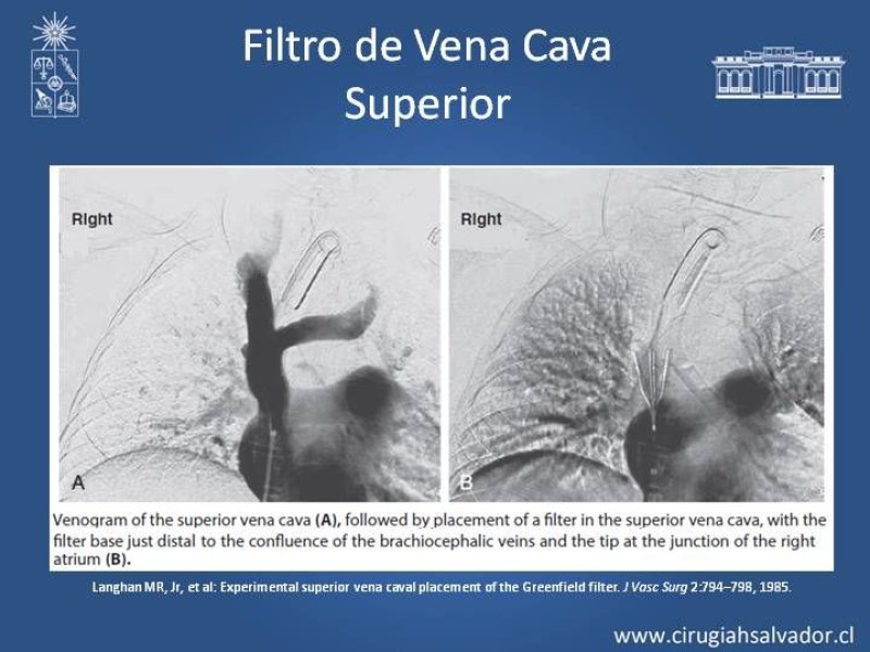 Diapositiva 17 de Filtro de Vena Cava