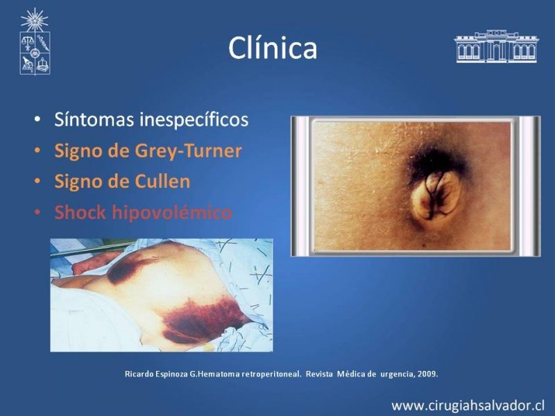 Diapositiva 3 de Hematoma Retroperitoneal Traumático