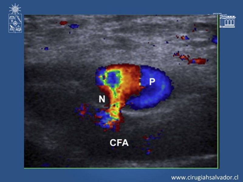 Diapositiva 7 de Pseudoaneurisma Post Angiografía