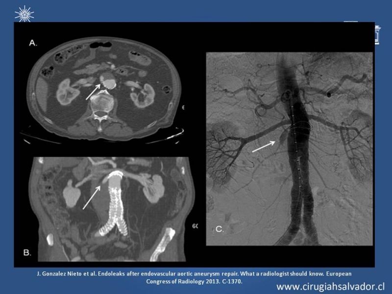 Diapositiva 13 de Endoleak post EVAR