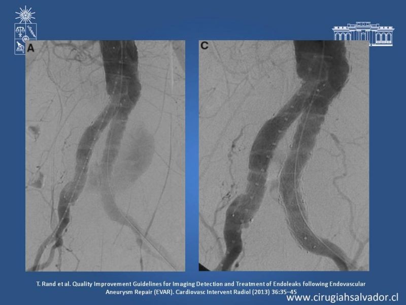 Diapositiva 17 de Endoleak post EVAR