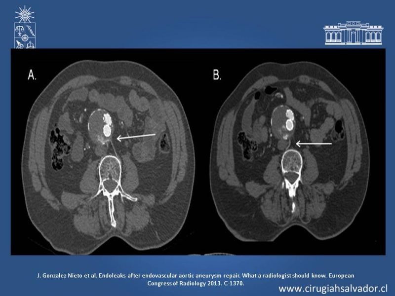 Diapositiva 20 de Endoleak post EVAR