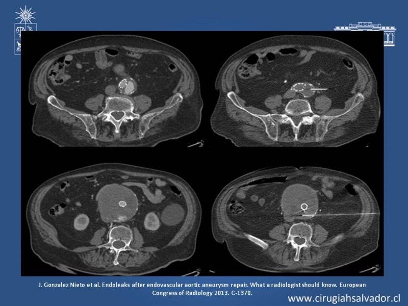 Diapositiva 27 de Endoleak post EVAR