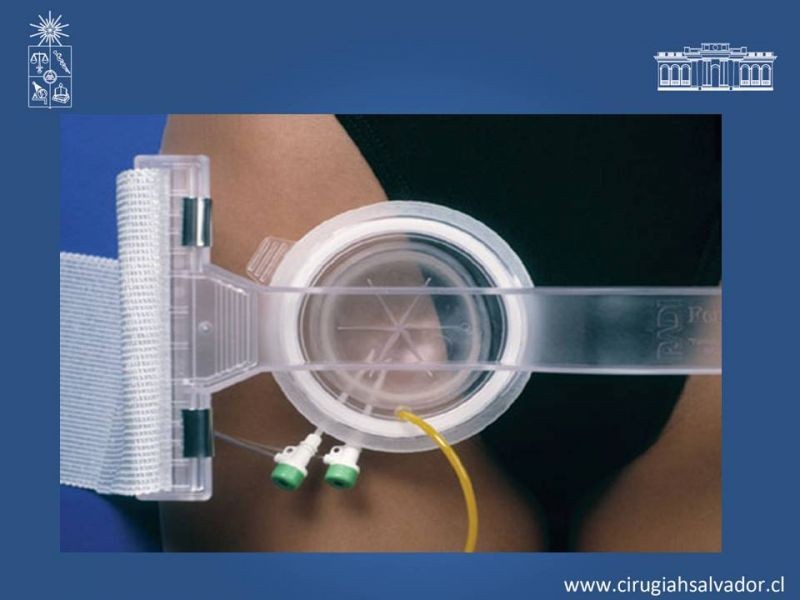 Diapositiva 18 de Pseudoaneurisma Post Angiografía