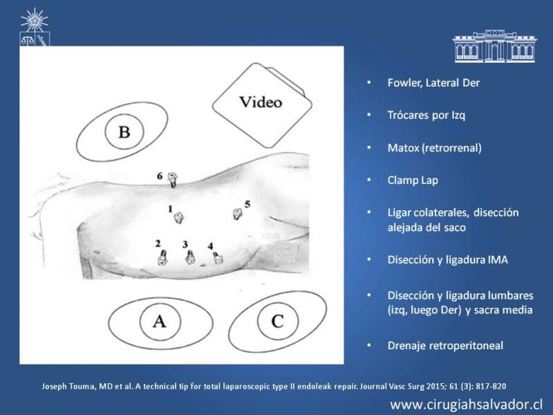 Diapositiva 33 de Endoleak post EVAR