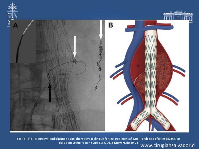 Diapositiva 30 de Endoleak post EVAR